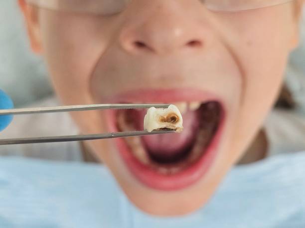 Best Emergency Root Canal Treatment in Seven Points, TX