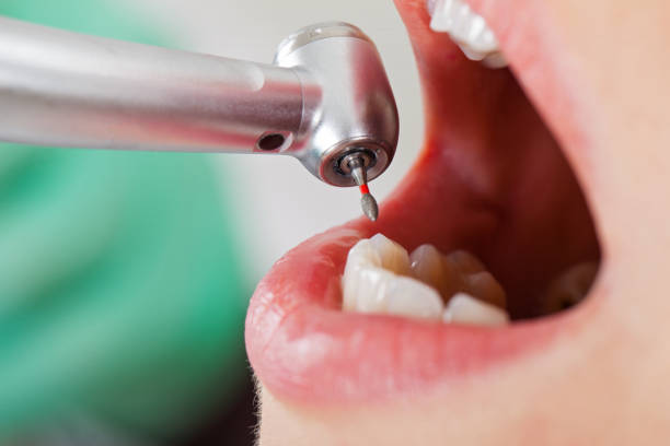 Best Emergency Root Canal Treatment in Seven Points, TX